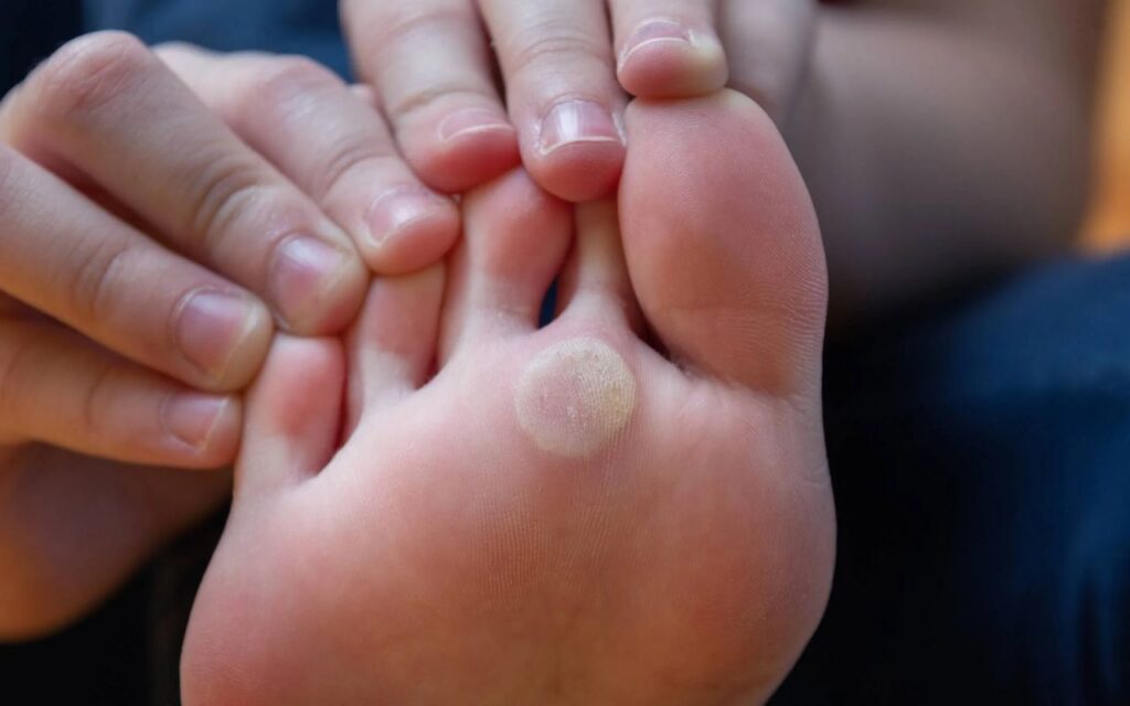 o que &eacute; olho de peixe